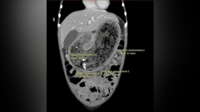 В Москве врачи удалили из желудка восьмилетней девочки крупный комок волос